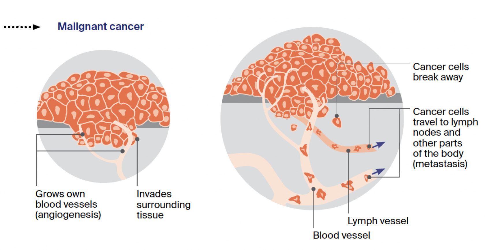 How cancer spreads: cell diagram